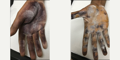 25-34 year old man treated with Botox - Patient shown after Iodine starch test preformed to show areas of sweat in black. Before treatment with Botox for Hyperhidrosis and at 2 weeks after treatment.