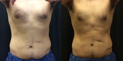 35-44 year old man treated with CoolTone - 6 Sessions of CoolTone for Abdominal Muscle Toning. 4 week transformation. Results may vary.