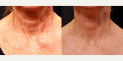 45-54 year old woman treated with Alastin Skincare - This patient had IPL Laser and 1540 Fractional Laser to her neck to improve her sun spots, skin quality, texture and tone.  She used Alastin Regenerating Skin Nectar two weeks before and after her treatments.  Here are her amazing results after only 3 weeks.  The Alastin Regenerating Skin Nectar helped prepare her skin for the laser treatments and accelerated her healing and downtime.