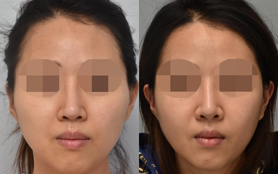 Woman treated with Cheekbone Reduction - Woman treated with Cheekbone Reduction