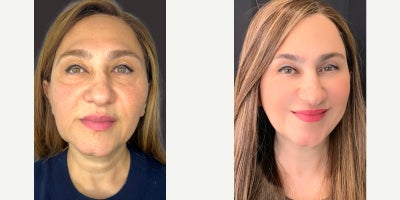 45-54 year old woman treated with Botox, HydraFacial, Morpheus8, Dermal Fillers, IPL - Results shown after a comprehensive skin-rejuvenation plan over 24 months . Years in the making - this transformation combines science, artistry, and consistency. By layering Morpheus8, fillers, botox, HydraFacial, and IPL treatments we rebuilt collagen, restored volume, and revealed radiant, even-toned skin. Supreme Skin achieved.