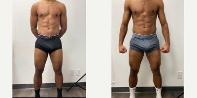 18-24 year old man treated with truSculpt flex - Four treatments of trusculpt 4 flex every week. Combined with daily, unchanged exercise routine and diet. Results 12 weeks after last flex treatment.