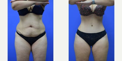 35-44 year old woman treated with Drainless Tummy Tuck, Tummy Tuck, Liposuction - 14 months post Dr. Bachilo's signature drainless tummy tuck and liposuction of full back