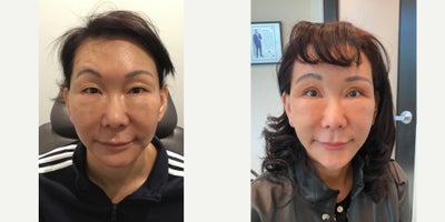 55-64 year old woman treated with Eyelid Surgery - Before & After: Upper Blepharoplasty performed by Dr. Almonte.
