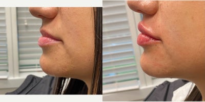 25-34 year old woman treated with Restylane Kysse - Restylane Kysse lip fillers with Dr. Wise at the Wise Center for Plastic Surgery in Wayne, NJ to create a plumped up and symmetrical look!