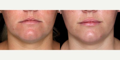 29year old woman treated with Volbella - 29year old woman treated with Volbella, Lip Fillers. Photos depict before and 2 weeks after treatment.