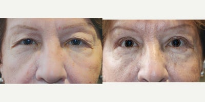 61 year old woman treated with Upper Blepharoplasty Surgery - 61 year old woman treated with Upper Blepharoplasty Surgery, giving the eyes a more youthful appearance.