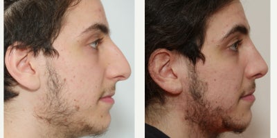 18-24 year old man treated with Rhinoplasty - Large nose, convex hump on dorsum, and low tip - all fixed and it looks natural