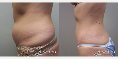 25-34 year old woman treated with Tumescent Liposuction - 6 months after Tumescent Liposuction