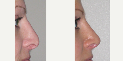 25-34 year old woman treated with Revision Rhinoplasty - Revision rhinoplasty to correct dorsal irregularity, improve tip projection and correct polybeak deformity. A cartilage rib graft was required to improve tip projection.