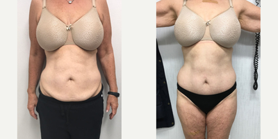 Tummy Tuck - Woman treated with Tummy Tuck