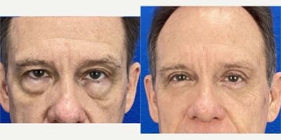 55-64 year old man treated with Double Eyelid Surgery, Eyelid Surgery - 55-64 year old man treated with Double Eyelid Surgery, Eyelid Surgery
