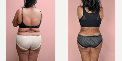 55-64 year old woman treated with Liposuction - This lovely patient requested help in improving her shape and removing the sagging skin from her abdomen. She was able to turn back the clock and look 30 years younger with a combination of tummy tuck and 360 liposuction.