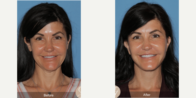 Woman treated with Facelift, Neck Lift - Woman treated with Facelift, Neck Lift