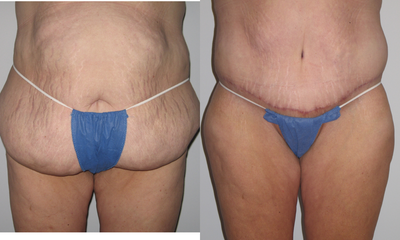42 Year Old Woman with Tummy Tuck and Body Lift - 
	42 year old woman with full abdominoplasty and lower transverse body lift.
