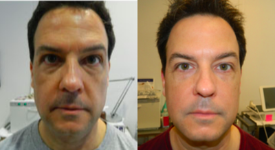 45-54 year old man treated with Dermapen - Three treatments with Dermapen spaced one month apart.