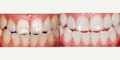18-24 year old man treated with Tooth Repair - We made porcelain filling in the anterior tooth of our patient in 45 minutes.