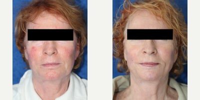 Surgical Removal of Facial Silicone Injection Improves Lips, Cheeks, and Comfort - Silicone injection removal of the face can restore a softer, healthier appearance when old foreign material begins causing swelling, discoloration, and discomfort. Our patient is a 64-year-old White female who had silicone injections placed in her cheeks and upper and lower lips 19 years ago. Over time, she developed facial swelling, changes in skin color, and pain related to the injected product, which led her to seek treatment from Dr. J. Timothy Katzen. Under general anesthesia, Dr. Katzen performed surgical silicone removal of the face, specifically treating the cheeks and both lips. This facial reconstructive procedure involves carefully opening the affected areas, identifying the silicone and surrounding scar tissue, and removing as much problematic material as safely possible while preserving natural facial structure. Silicone injections in the face can trigger chronic inflammation, firmness, irregular texture, visible distortion, and discoloration that do not improve without surgery. By removing the foreign material and refining the damaged tissue, this type of facial silicone removal surgery can improve comfort, contour, and skin appearance. Her photos were taken 3 months after surgery and already show remarkable results, including less swelling, improved color, and a more natural facial contour. She is also relieved of most of her pain, which makes her outcome especially meaningful.