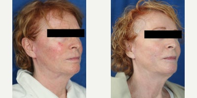 Surgical Removal of Facial Silicone Injection Improves Lips, Cheeks, and Comfort - Silicone injection removal of the face can restore a softer, healthier appearance when old foreign material begins causing swelling, discoloration, and discomfort. Our patient is a 64-year-old White female who had silicone injections placed in her cheeks and upper and lower lips 19 years ago. Over time, she developed facial swelling, changes in skin color, and pain related to the injected product, which led her to seek treatment from Dr. J. Timothy Katzen. Under general anesthesia, Dr. Katzen performed surgical silicone removal of the face, specifically treating the cheeks and both lips. This facial reconstructive procedure involves carefully opening the affected areas, identifying the silicone and surrounding scar tissue, and removing as much problematic material as safely possible while preserving natural facial structure. Silicone injections in the face can trigger chronic inflammation, firmness, irregular texture, visible distortion, and discoloration that do not improve without surgery. By removing the foreign material and refining the damaged tissue, this type of facial silicone removal surgery can improve comfort, contour, and skin appearance. Her photos were taken 3 months after surgery and already show remarkable results, including less swelling, improved color, and a more natural facial contour. She is also relieved of most of her pain, which makes her outcome especially meaningful.