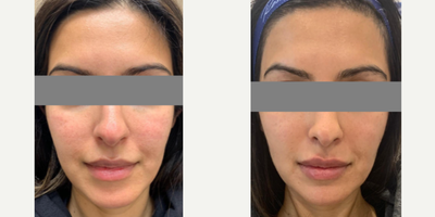Woman treated with PRP Injections - Woman treated with PRP Injections