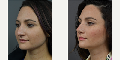 25-34 year old woman treated with Rhinoplasty, Septoplasty, Inferior Turbinate Reduction - Patient is 6 months post op Cosmetic & Functional Rhinoplasty.She presented at consult with complaints of breathing difficulty, unhappiness overall size and dorsal hump.Assessment of the patient revealed a deviated septum, hypertrophy of nasal turbinates and desired cosmetic change. The patient appeared to be a good candidate for primary open rhinoplasty, septoplasty and inferior turbinate reduction for treatment of the aforementioned deformities. The goals for treatment included an increase in tip rotation, shorten the nose, narrow the tip, reduce dorsal hump and narrow the bony base. The recommended plan included cephalic trim for the tip, dome sutures for the tip, columella strut for the tip, tip graft, to take down hump and an osteotomy for open roof for the dorsum.
