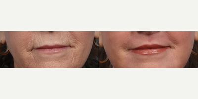65-74 year old woman treated with Chemical Peel - Peri Oral Hetter Peel