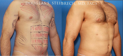 Man treated with Bicep Implants - Man treated with Bicep Implants