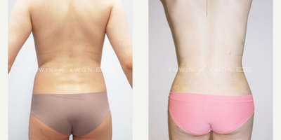 25-34 year old woman treated with MTF Body Contouring with Hip Implants - 25-34 year old female transgender patient treated with MTF Body Contouring with placement of bilateral Implantech hip implants and 360 liposuction to help accentuate the hourglass figure.