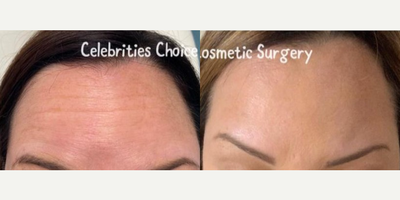 Woman treated with Botox - Woman treated with Botox