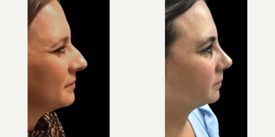 Woman treated with Rhinoplasty - Discover how a subtle change can make a big difference! Previously, our beautiful patient had a prominent arch on her nose that disrupted the balance of her facial features. With Dr. Carlos Wolfs skilled approach, her profile now boasts a refined, smooth contour. This rhinoplasty not only transformed her nose but enhanced the overall harmony of her face.