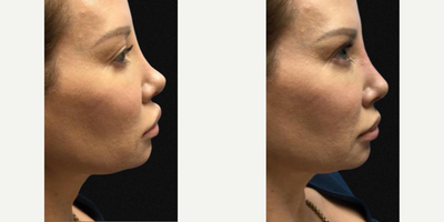 Woman treated with Revision Rhinoplasty, Nonsurgical Nose Job, Restylane - Immediate before & after of this Non-Surgical Revision Rhinoplasty.This patient had an overdone Rhinoplasty years ago by a different doctor and has not been happy. In order for me to get her to where she wants to be without another surgery I used Restylane USA to give her a little more volume in the bridge of her nose. Only took a few minutes and now she is a happy patient - Dr. Carlos Wolf