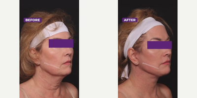 25-34 year old woman treated with Facelift, Neck Lift - 25-34 year old woman treated with Facelift, Neck Lift2 months post-op