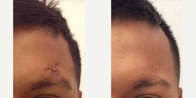 25-34 year old man treated with IPL - A 25-year-old Male patient treated with IPL Laser Treatment to reduce the appearance of scarring above the eyebrow.
