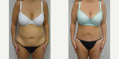 45-54 year old woman treated with Tummy Tuck Revision - A mother of 1 in her early 50s who had a miniabdominplasty elsewhere in 2008 but was still bothered by the rolls of her abdomen. She would like to be able to wear pants with a belt. She is shown before and again, 10  months after an extended abominoplasty. Often patients come in and ask for a mini abdominplasty- they want the minimum of surgery but still want a maximum result. I find that it is better to find out what is bothering a patient, make the diagnosis and then come up with the best procedure to treat the diagnosis. As in this case, she asked her first plastic surgeon for a mini abdominplasty, but her treatment plan was incorrect. In fact she really needed an extended abominoplasty to contour the sides better.