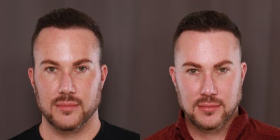 18-24 year old man treated with Moxi - 1 Moxi and Sylfirm Treatment