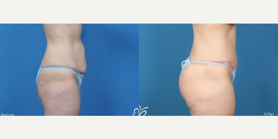 Woman treated with Tummy Tuck - Woman treated with Tummy Tuck