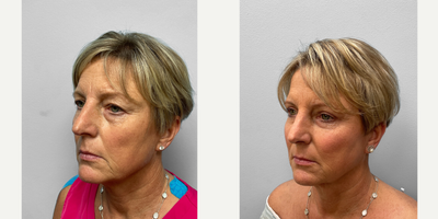 55-64 year old woman treated with Eyelid Surgery, Laser Resurfacing - This woman in her late fifties came to inquire about facial rejuvenation options with Dr. Howell who recommended an upper eyelid blepharoplasty, Juvderm, and TFX CO2 laser resurfacing in the future.  She looks great and is shown before and 3 months after surgery and filler.