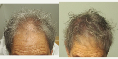 65-74 year old woman treated with Scalp MicroPigmentation SMP - 65-74 year old woman treated with Scalp MicroPigmentation SMP