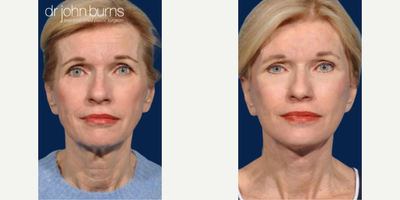 Woman treated with Laser Resurfacing - Woman treated with Facelift, Neck Lift, and Laser Resurfacing