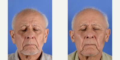 75 and up year old man treated with Earlobe Repair - This gentleman presented with sagging earlobes. He felt that his ears did not match the rest of his appearance. We decided on in-office earlobe reduction. This involves numbing the earlobe and planning the amount of skin to be removed as well as contour to be achieved. His reduction was significant and at one month.