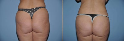 Brazilian Butt Lift (Fat Transfer) - This 37 year old mother of one came to office for reshaping of her hips abdomen and buttocks.  She was fit, and didn't need to lose any weight.  But Mother nature gave her some fatty deposits of the lower abdomen, hips and outer thighs.  And looking at her it was clear that we could reshape her buttocks by recycling the fat we would remove by liposuction, reinjecting into the hollows of the lower outer buttocks.


We use VASER Lipo, a gentle ultrasound method of fat  removal to clear out the excess fat.  Then we re-injected the fat into her buttocks.&nbsp;