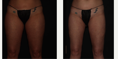 45-54 year old woman treated with Lipedema Surgery - Stage 1 Lipedema patient that had Lipedema Reduction surgery to her inner and anterior thighs