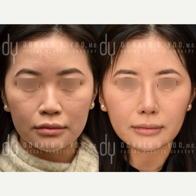 25-34 year old woman treated with Asian Rhinoplasty - Asian Rhinoplasty with Rib Cartilage and DCF