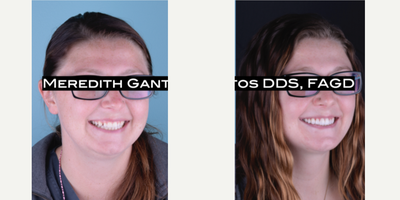 25-34 year old woman treated with Gum Lift - Gum lift + Porcelain Veneers