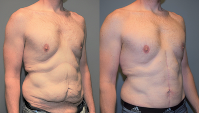 25-34 year old man treated with Male Tummy Tuck - This 30 year old man is 6'4 tall and weighs 215 pounds. He lost 100 pounds with diet and exercise which has left him with significant loose skin. He had enough loose skin that an inverted -T, (also called Fleurs de Lis), type of abdominoplasty was done to achieve the most tightening possible. This technique does leave a scar down the middle, but for this patient, was the better compromise to achieve his desired goal. His old ruptured appendix scar can be seen in the before pictures. The after pictures were taken at nine months.