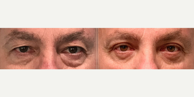 55-64 year old man treated with Eyelid Surgery, Double Eyelid Surgery, Areola Reduction Surgery - 56-year-old man treated with Upper and Lower BlepharoplastyHeight: 511 Weight: 226 pounds BMI: 31.5 Time After Surgery: 1 MonthGoals: wanted to treat the hanging upper eyelid skin affecting his vision, and remove the fat from his lower eyelids