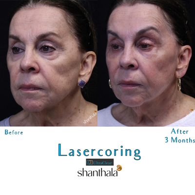 UltraClear Laser-Coring by Dr. Shanthala - 74 yrs old patient after Full face & Neck Laser-Coring with UltraClear laser resulted in improving skin quality, dyschromia, laxity.