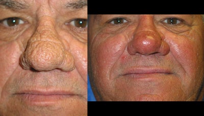 CO2 Fractional Laser - 
	dyschromia of the face and wrinkled face. Condition occurred as a result of sun exposure
