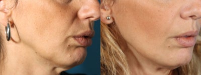 Radiesse filler for jowls and nasolabial folds (liquid facelift) - Radiesse is an excellent deep volumizing filler. For this patient, Radiesse was used to soften the nasolabial folds, augment the cheek bones, and smooth the jawline. Radiesse injections help to hide the jowls and stimulate collagen production in the deep dermal layers. It can work well for patients who are not yet ready for a facelift and is sometimes called a non-surgical facelift.