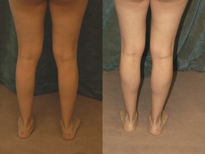 Women's Calf Augmentation  - 
	Women&#39;s Calf Augmentation W/Implants
